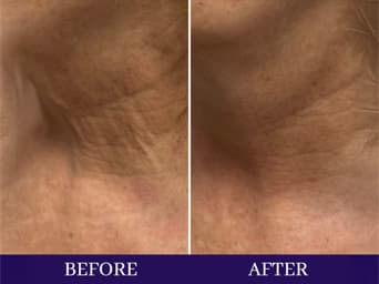Facial cryotherapy treatment process