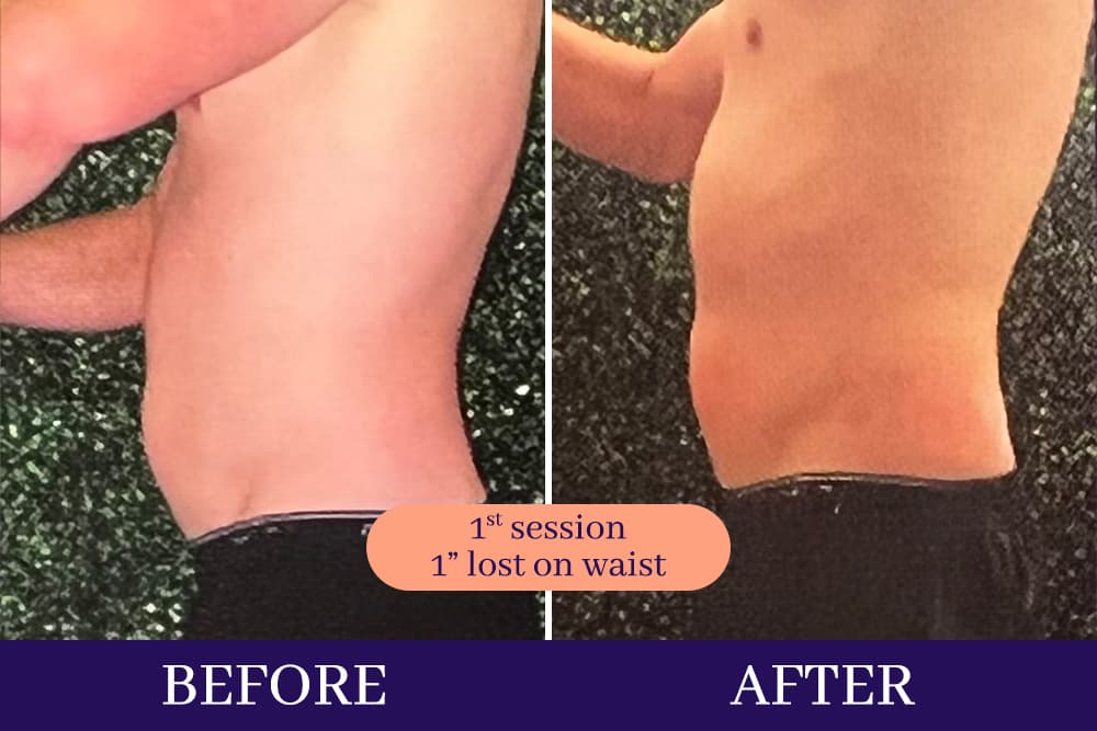 Cryo slimming treatment chamber